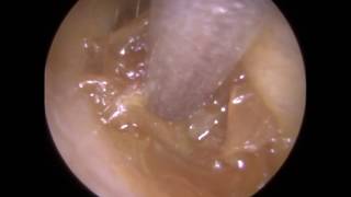 258  Soft Impacted and Occluding Ear Wax Removal off Eardrum Mr Neel Raithatha [upl. by Barbaresi]