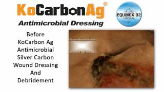 KoCarbon Ag Antimicrobial Silver Carbon Wound Dressing Case Study 3  Healed A Sacral Pressure Ulcer [upl. by Annavoeg32]