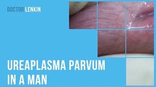 😟 Ureaplasma parvum in a man [upl. by Gratiana]