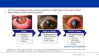 Understanding Vernal Keratoconjunctivitis VKC Not “Just an Allergy” [upl. by Venola]