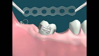 Dental Video of Molar Uprighting with Implants [upl. by Shiroma]