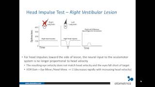 ICS Impulse vHIT Introduction and overview of underlying physiology [upl. by Omsoc71]