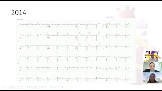 Diagnosing ATTR Amyloidosis Echocardiography is necessary but not sufficient PseudoNegative TcPyP [upl. by Ainirtac]