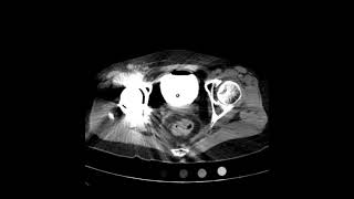 Bladder Rupture CT Cysto Axial JETem 2021 [upl. by Halbeib123]