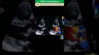 Prosthetic Valve Complications Dehiscence Paravalvular leakage Endocarditis [upl. by Draude]