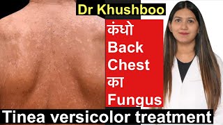 Tinea Versicolor Treatment  सेहुआ करोडियासीप Tinea body fungus treatment [upl. by Tirzah865]