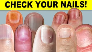 9 Things Your Nails Can Tell You About Your Health [upl. by Yleik]