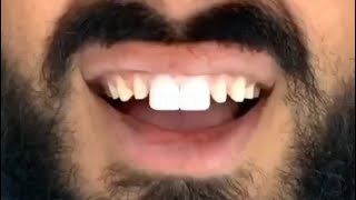 CHANGING MY CROWNS IN TURKEY veneers teeth dentist dentalcentreturkey turkey whiteteeth [upl. by Emarie600]