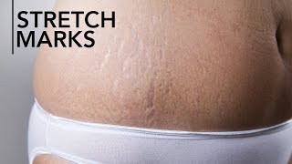 What are stretch marks Why do they happen [upl. by Buyer]