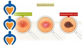 Huidkanker  Basaalcelcarcinoom video 2 van 5 [upl. by Malita]