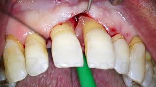 Minimally Invasive Periodontal Surgery [upl. by Almire]