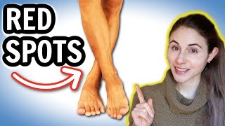 Why you get RED SPOTS ON THE LEGS amp HOW TO GET RID OF THEM  Dermatologist DrDrayzday [upl. by Karl]