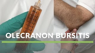 Olecranon Bursitis [upl. by Darahs109]