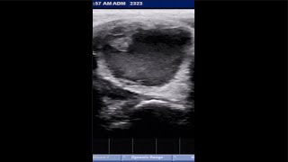 THYROID CYST ultrasound hormones thyroid [upl. by Demha606]