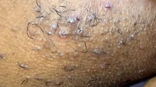 INGROWN HAIR REMOVAL 119 [upl. by Gladys]