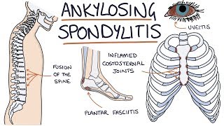 Ankylosing Spondylitis Visual Explanation for Students [upl. by Suolhcin]