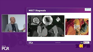 Identification and treatment of subclinical transcatheter valve thrombosis  EuroPCR 2024 [upl. by Urbannal]