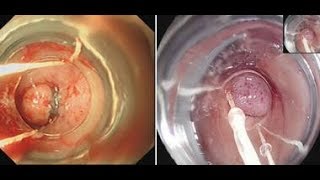 My Hemorrhoids banding Experience 2 weeks after review [upl. by Ahsratal539]