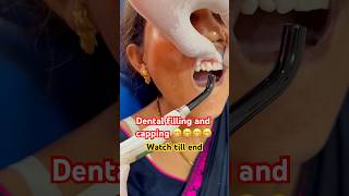 Front teeth filling  Root canal on front teeth  viralvideo [upl. by Ditter]