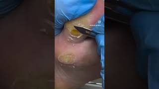 Cauterization of a wart with medical nitric [upl. by Mayce]