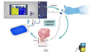 HCC 1472Lesson16bElectrosurgery Monopolar vs Bipolar devices [upl. by Damon]