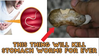 Get Rid of Stomach Worms At Home Intestinal Worms Home Remedies [upl. by Idhem946]