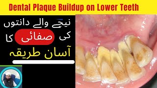 How to Prevent DENTAL PLAQUE  To Cure Gum Recession Gingivitis Gum Bleeding ateeqdentalcare [upl. by Hakan]