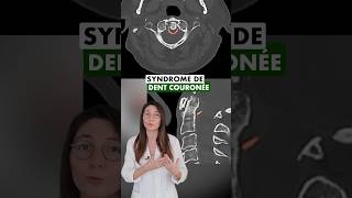 🦷👑 Syndrome de la dent couronnée  une cause de douleurs cervicales [upl. by Airyt]