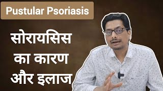 Pustular Psoriasis  सोरायसिस का कारण और इलाज़ psoriasis psoriasistreatment psoriasissolution [upl. by Leeth155]