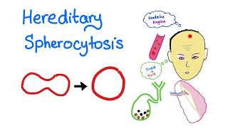 Hereditary Spherocytosis HS  Red Blood Cell Disorders  Hematology [upl. by Lareena173]