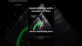 Coarctation Of Aorta corrected with Stent echocardiography for Beginners cardiology echo [upl. by Calvina]