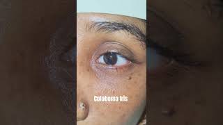 Iris coloboma Slit lamp examination of eye [upl. by Skylar]