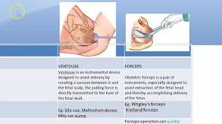 Obstetrics 684 Ventouse vs Forcep Delivery advantage difference vacuum assisted operative instrument [upl. by Frost]