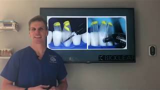 The best and easiest solution to closing tooth gaps Bioclear  Black triangles in teeth [upl. by Stoddard895]