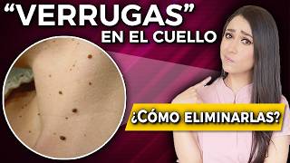 quotVERRUGAS” en el cuello l Cómo ELIMINARLAS qué son y por qué salen👩🏻‍⚕️ [upl. by Eittam174]