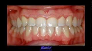 GingivoplastyGingivectomy [upl. by Enymzaj]