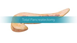 Total Pancreatectomy How the Procedure Is Performed [upl. by Ahsinehs]