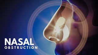 What causes Nasal Obstruction [upl. by Madden]