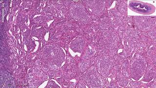 Neuroendocrine Tumor  Appendix  Histopathology [upl. by Olsson]