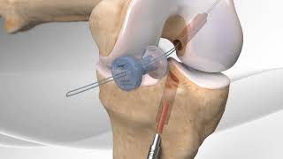 Rupture du ligament croisé antérieur  Chirurgie reconstruction LCA ligamentoplastie  Dr Tournemine [upl. by Godric]