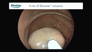 Endoscopic Polypectomy with Eleview™ [upl. by Katinka]