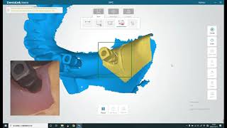 Fussen FIOS implant case training [upl. by Tisman]