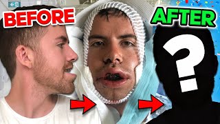 I HAD DOUBLE JAW SURGERY  My experience with an underbite Before and After [upl. by Powe372]