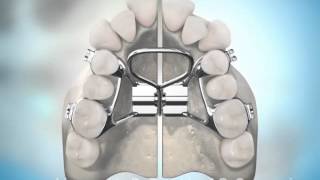 Surgically Assisted Palatal Expansion [upl. by Allix282]