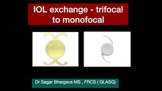 Intraocular Lens Exchange  IOL EXCHANGE from Trifocal to Monofocal  Dr Sagar Bhargava [upl. by Hogarth751]