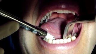 Sialolitiasis Obstrucción de Glándula Salival [upl. by Edroi]