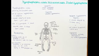 Hypophosphatemic Rickets Xlinked Hypophosphatemia Vitamin D resistant Rickets [upl. by Philbrook]