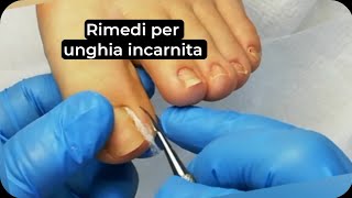 Rimedi per unghia incarnita Come applicare il cotone sotto lunghia incarnita [upl. by Pogue355]