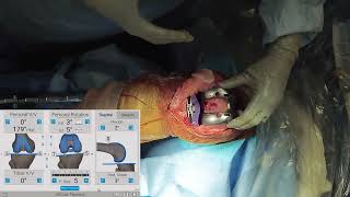 Measured Resection Approach in TKA with Joseph Locker MD [upl. by Isaac]