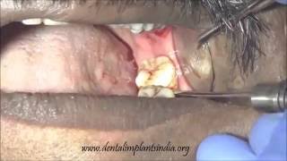 Second Third mandibular molar extraction by cowhorn forceps [upl. by Remmos243]